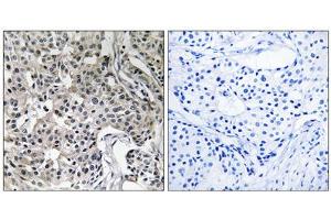 Immunohistochemistry analysis of paraffin-embedded human breast carcinoma tissue using USP19 antibody. (USP19 抗体  (Internal Region))