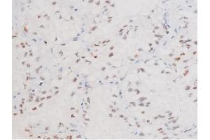 ABIN6267578 at 1/200 staining Human lung cancer tissue sections by IHC-P. (FOXO4 抗体  (pThr451))
