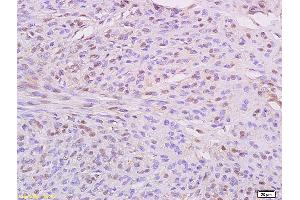 Formalin-fixed and paraffin embedded human cervical carcinoma labeled with Anti IKBKE/IKKi Polyclonal Antibody, Unconjugated (ABIN754033) at 1:200 followed by conjugation to the secondary antibody and DAB staining