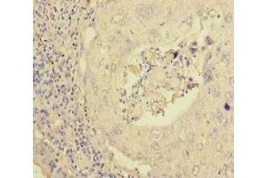 Immunohistochemistry of paraffin-embedded human lung cancer using ABIN7162979 at dilution of 1:100 (PEX16 抗体  (AA 132-336))