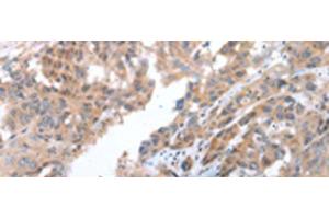 Immunohistochemistry of paraffin-embedded Human breast cancer tissue using COX7C Polyclonal Antibody at dilution of 1:40(x200) (COX7C 抗体)