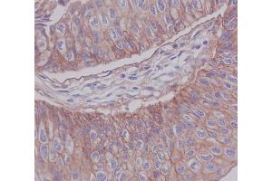 Immunohistochemical analysis of paraffin-embedded human blader cancer, using JAM1 Antibody. (Recombinant F11R 抗体)