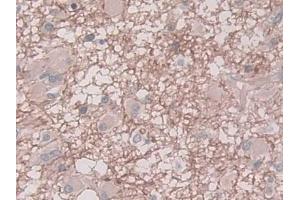 DAB staining on IHC-P; Samples: Human Glioma Tissue) (PAI1 抗体  (AA 25-402))