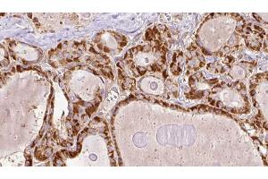 ABIN6267201 at 1/100 staining Human thyroid cancer tissue by IHC-P.
