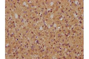 IHC image of ABIN7174981 diluted at 1:200 and staining in paraffin-embedded human glioma cancer performed on a Leica BondTM system. (Myosin XVIIIA 抗体  (AA 1849-2054))