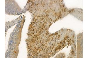 ABIN6261269 and ABIN6268950 at 1/100 staining human colon carcinoma by IHC-P. (Dematin 抗体  (C-Term))