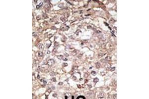Formalin-fixed and paraffin-embedded human cancer tissue reacted with the primary antibody, which was peroxidase-conjugated to the secondary antibody, followed by AEC staining. (TLR1 抗体  (C-Term))