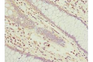 Immunohistochemistry of paraffin-embedded human colon cancer using ABIN7173929 at dilution of 1:100 (TUSC2 抗体  (AA 1-110))