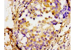 Immunohistochemistry of paraffin-embedded human breast cancer using ABIN7172602 at dilution of 1:100 (SOX11 抗体  (AA 241-341))