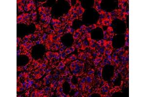 IF analysis of MYD88 using anti-MYD88 antibody (ABIN3043887) MYD88 was detected in paraffin-embedded section of human mammary cancar tissues.