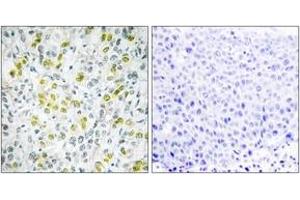 Immunohistochemistry analysis of paraffin-embedded human liver carcinoma tissue, using CHD4 Antibody. (CHD4 抗体  (AA 571-620))
