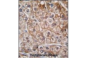 Formalin-fixed and paraffin-embedded human hepatocarcinoma tissue reacted with BR2 antibody (N-term), which was peroxidase-conjugated to the secondary antibody, followed by DAB staining. (BMPR2 抗体  (N-Term))