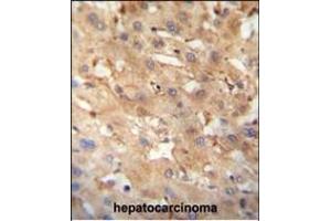 NEU4 antibody (C-term) (ABIN654343 and ABIN2844112) immunohistochemistry analysis in formalin fixed and paraffin embedded human hepatocarcinoma followed by peroxidase conjugation of the secondary antibody and DAB staining. (Sialidase 4 抗体  (C-Term))