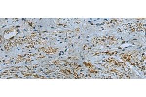 Immunohistochemistry of paraffin-embedded Human cervical cancer tissue using IL17RD Polyclonal Antibody at dilution of 1:40(x200) (IL17RD 抗体)
