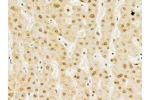 Lamin A/C Mouse Monoclonal Antibody at 1/100 staining human liver cancer by IHC-P.