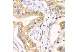 Immunohistochemistry of paraffin-embedded human liver cancer using HAGH antibody at dilution of 1:100 (x40 lens). (HAGH 抗体)