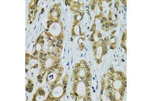 Immunohistochemistry of paraffin-embedded human rectal cancer using RPS7 antibody. (RPS7 抗体  (AA 1-194))