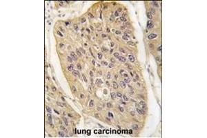 Formalin-fixed and paraffin-embedded human lung carcinoma tissue reacted with WIF1 (Human C-term) (ABIN389184 and ABIN2839347) , which was peroxidase-conjugated to the secondary antibody, followed by DAB staining. (WIF1 抗体  (N-Term))