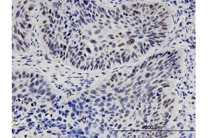 Immunoperoxidase of monoclonal antibody to HNF1B on formalin-fixed paraffin-embedded human lung adenocarcinoma. (HNF1B 抗体  (AA 29-118))