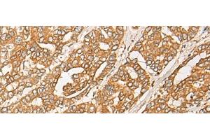 Immunohistochemistry of paraffin-embedded Human liver cancer tissue using GNB1L Polyclonal Antibody at dilution of 1:35(x200) (GNB1L 抗体)