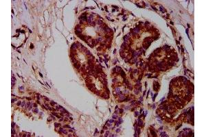 IHC image of ABIN7168291 diluted at 1:400 and staining in paraffin-embedded human breast cancer performed on a Leica BondTM system. (MOV10L1 抗体  (AA 336-425))