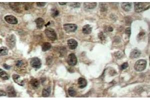 Immunohistochemistry (IHC) analyzes of FoxO3 antibody in paraffin-embedded human breast carcinoma tissue. (FOXO3 抗体)