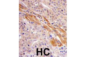 Formalin-fixed and paraffin-embedded human hepatocellular carcinoma reacted with PGK1 polyclonal antibody  , which was peroxidase-conjugated to the secondary antibody, followed by DAB staining. (PGK1 抗体  (Internal Region))