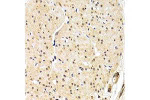 Immunohistochemistry of paraffin-embedded human gastric cancer using TERF1 antibody. (TRF1 抗体)