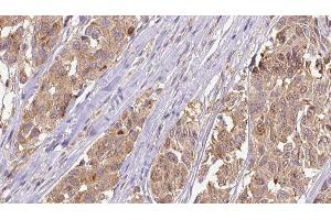 ABIN6275304 at 1/100 staining Human Melanoma tissue by IHC-P. (Neuromedin U 抗体  (C-Term))