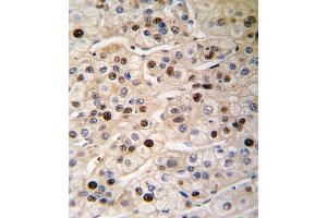 Formalin-fixed and paraffin-embedded human hepatocarcinoma tissue reacted with PCNA antibody (Center) (ABIN389345 and ABIN2839454) , which was peroxidase-conjugated to the secondary antibody, followed by DAB staining. (PCNA 抗体  (AA 89-117))