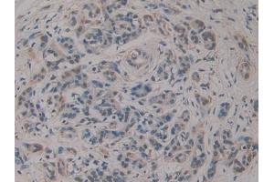 Detection of RSPO3 in Human Pancreatic cancer Tissue using Polyclonal Antibody to R-Spondin 3 (RSPO3) (R-Spondin 3 抗体  (AA 22-272))