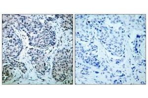 Immunohistochemical analysis of paraffin-embedded human breast carcinoma tissue using SEK1/MKK4(Phospho-Thr261) Antibody(left) or the same antibody preincubated with blocking peptide(right). (MAP2K4 抗体  (pThr261))