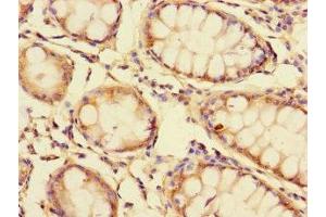 Immunohistochemistry of paraffin-embedded human colon cancer using ABIN7154300 at dilution of 1:100 (GOLPH3L 抗体  (AA 6-285))