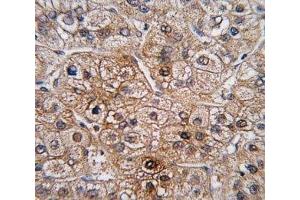 IHC analysis of FFPE human hepatocarcinoma tissue stained with BMPR2 antibody (BMPR2 抗体  (AA 28-59))