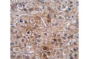 IHC analysis of FFPE human hepatocarcinoma tissue stained with BMPR2 antibody (BMPR2 抗体  (AA 28-59))