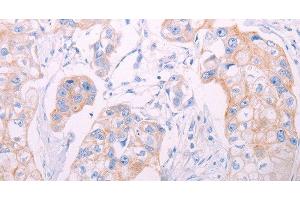 Immunohistochemistry of paraffin-embedded Human breast cancer tissue using ADAMTS14 Polyclonal Antibody at dilution 1:50 (ADAMTS14 抗体)