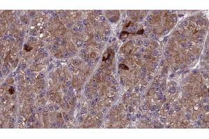ABIN6273987 at 1/100 staining Human liver cancer tissue by IHC-P. (OR3A1 抗体)