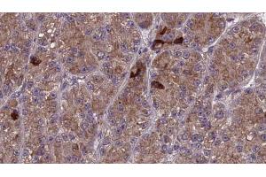 ABIN6273987 at 1/100 staining Human liver cancer tissue by IHC-P.