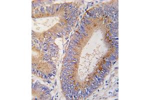 Formalin-fixed and paraffin-embedded human colon carcinoma tissue reacted with GDF11 antibody (N-term) (ABIN388814 and ABIN2839133) , which was peroxidase-conjugated to the secondary antibody, followed by DAB staining. (GDF11 抗体  (N-Term))