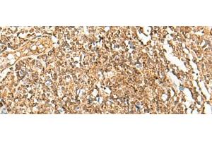 Immunohistochemistry of paraffin-embedded Human tonsil tissue using POLH Polyclonal Antibody at dilution of 1:45(x200) (POLH 抗体)