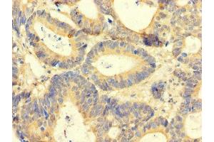 Immunohistochemistry of paraffin-embedded human colon cancer using ABIN7144028 at dilution of 1:100 (Amphiregulin 抗体  (AA 107-148))