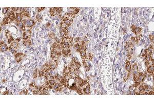 ABIN6278946 at 1/100 staining Human liver cancer tissue by IHC-P. (PLCH2 抗体  (N-Term))