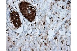 Immunohistochemical staining of paraffin-embedded Adenocarcinoma of colon tissue using anti-ACLY mouse monoclonal antibody. (ACLY 抗体)
