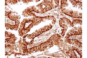 IHC-P Image ME1 antibody detects ME1 protein at cytosol on human ovarian carcinoma by immunohistochemical analysis. (ME1 抗体)