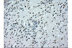Immunohistochemical staining of paraffin-embedded Adenocarcinoma of breast tissue using anti-BRAF mouse monoclonal antibody. (BRAF 抗体)