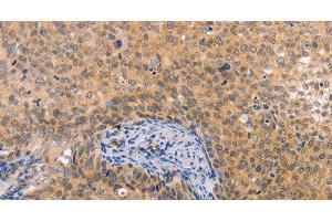 Immunohistochemistry of paraffin-embedded Human cervical cancer tissue using pVHL Polyclonal Antibody at dilution 1:40 (VHL 抗体)