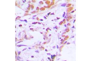 Immunohistochemical analysis of TCF7 staining in human breast cancer formalin fixed paraffin embedded tissue section.