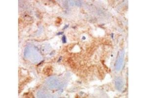 cKit antibody was used in immunohistochemistry on breast carcinoma. (KIT 抗体  (AA 9-40))