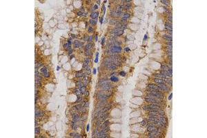 Immunohistochemistry of paraffin-embedded human rectal cancer using MMP25 antibody (ABIN5971552) at dilution of 1/200 (40x lens). (MMP25 抗体)