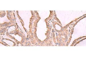 Immunohistochemistry of paraffin-embedded Human thyroid cancer tissue using EEF1D Polyclonal Antibody at dilution of 1:65(x200) (EEF1D 抗体)